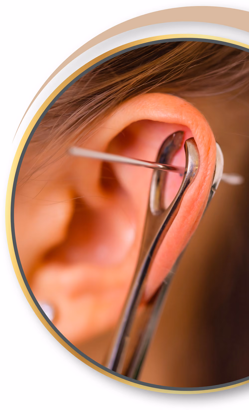Akupunktur Piercing von Nadelkust für Düren