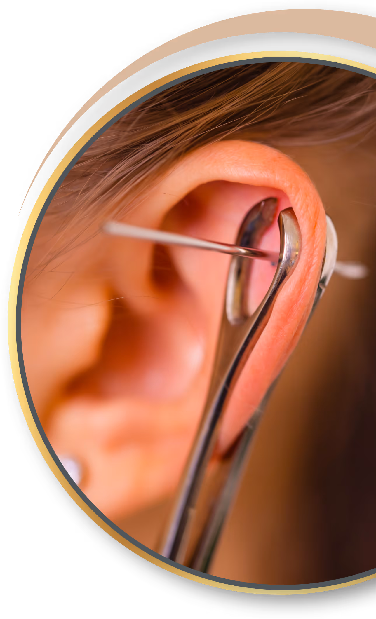 Akupunktur Piercing von Nadelkust für Simmerath 